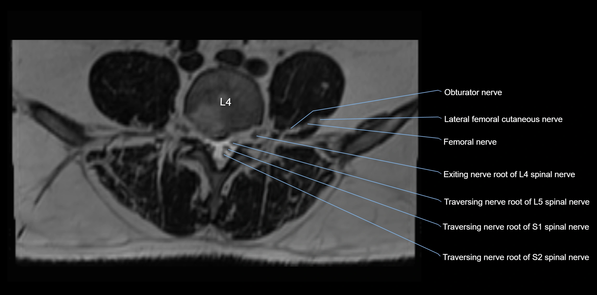 MR lumbosacral plexus axial cross sectional anatomy 3T  radiology  image-img-1008001-00044.webp